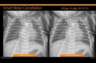 Webinar: AI Delivers Radiation Dose Reduction; Improved Image Quality