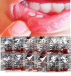 BECOSULES CAPSULES BICASULE Vitamin B-complex Help For Sore Tongue And Mouth